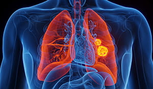 Doenças respiratórias | Quando inaladas as partículas da poeira metálica penetram nos órgãos do sistema respiratório dos trabalhadores. | Nederman